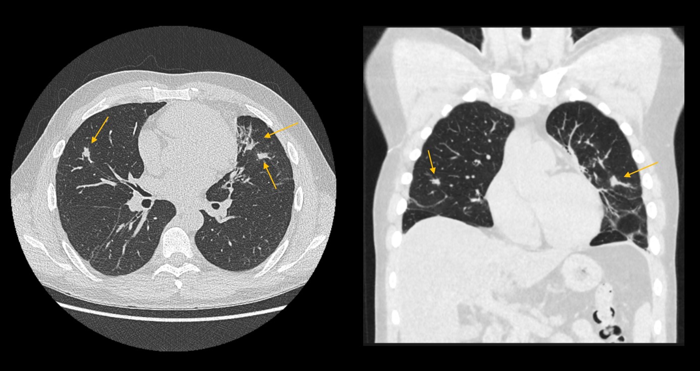 kasuistik_egpa_rare-disease-..